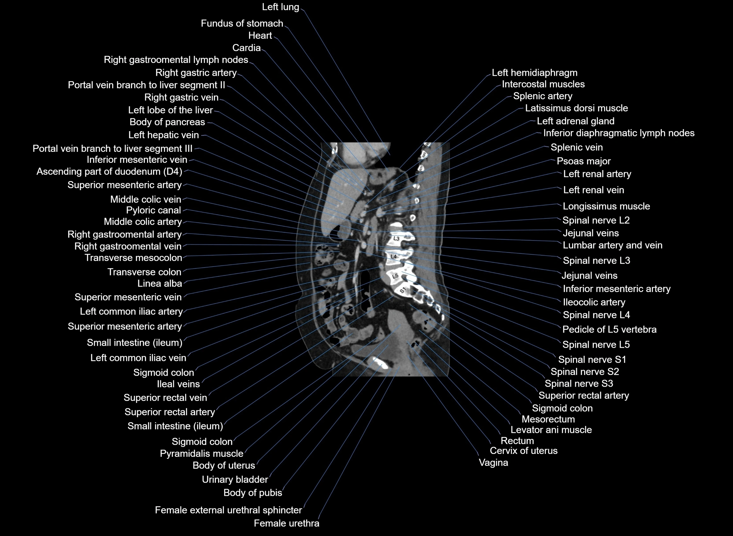 CT Abdomen sagittal cross sectional anatomy labelled radiology image -00054.webp